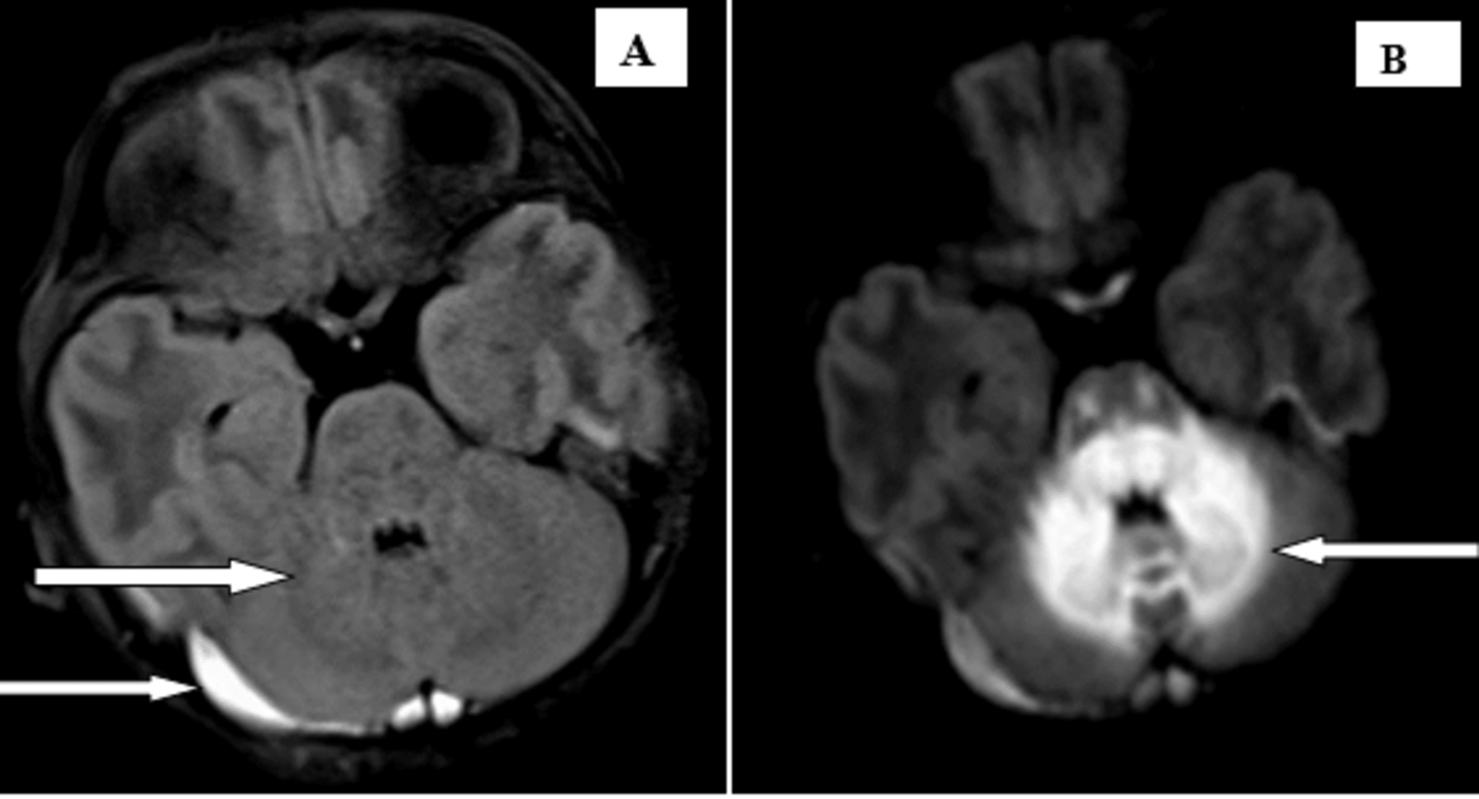 Maple Syrup Urine Disease An Cause of Neonatal Febrile
