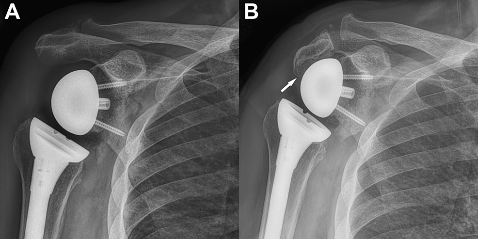 S One-shoulder One-piece Rib Fixation Strap Post-cardiothoracic