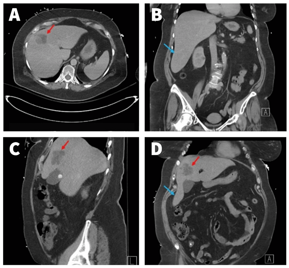 Incidental Finding of Riedel’s Lobe of the Liver and Intrahepatic