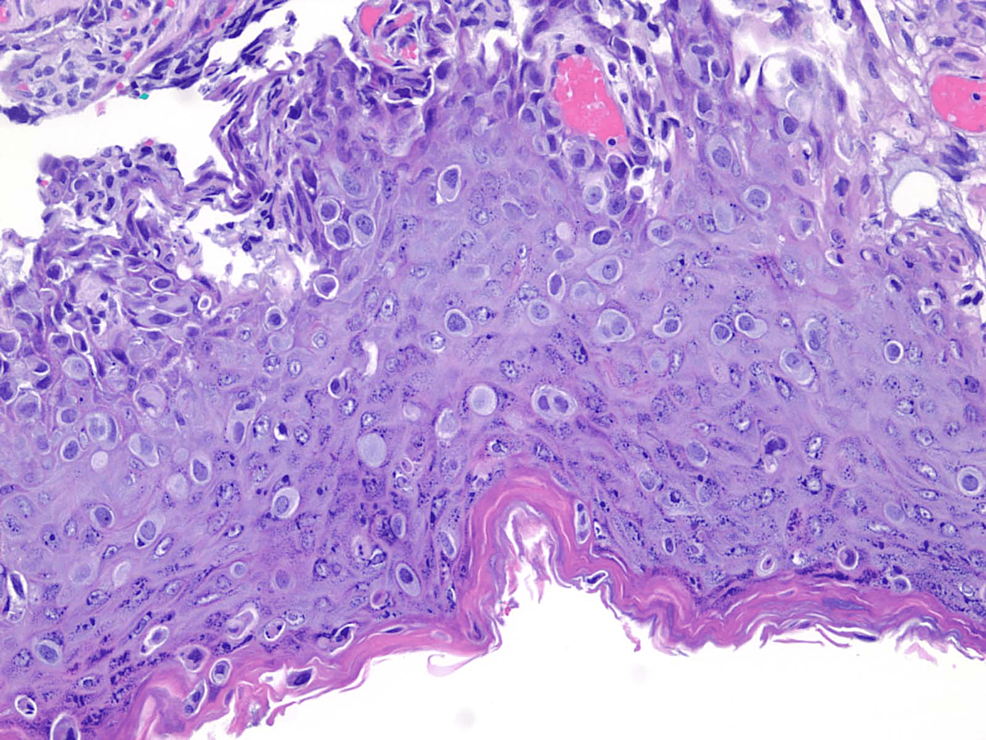 Cureus Studying the Presentation of Paget Disease of the Breast
