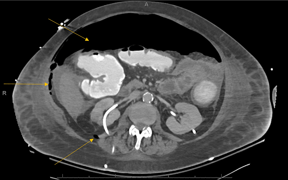 Cureus Green Cytoplasmic Neutrophilic Inclusion Bodies in a Patient
