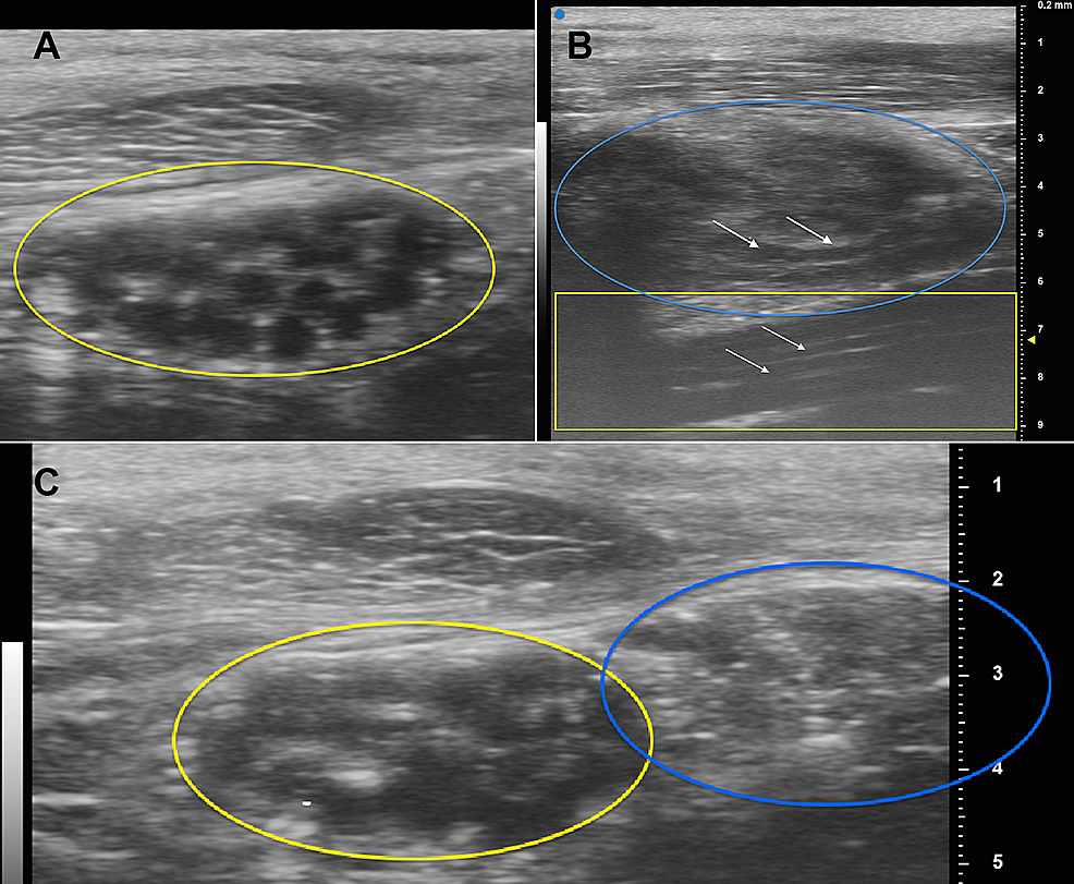 Cureus Ultrahighfrequency Ultrasound to Assess Nerve Fascicles in