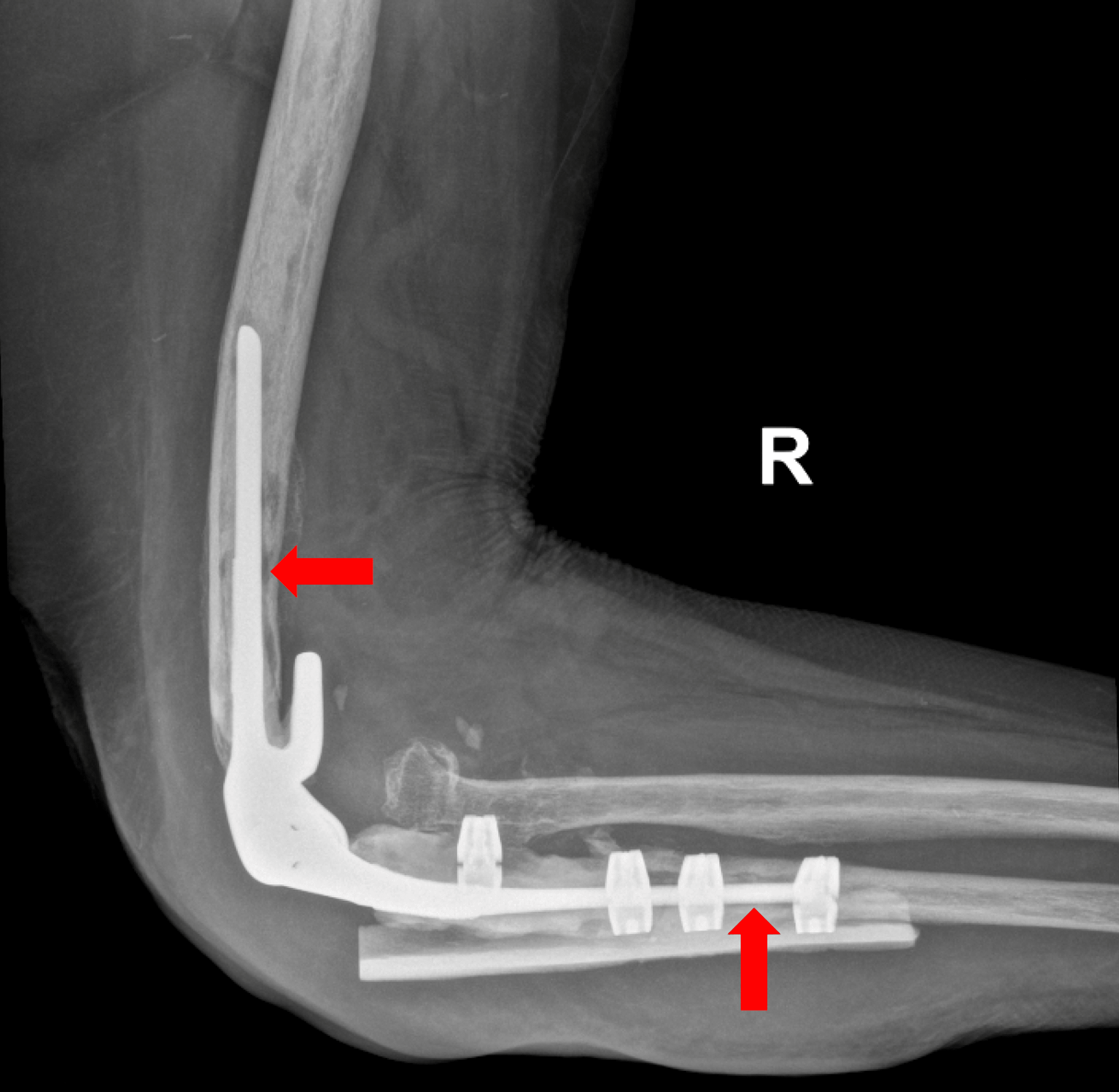 An Case of Prosthetic Elbow Joint Infection Caused by