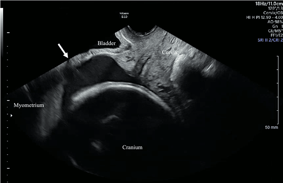 Uterine Dehiscence In The Early Third Trimester A Report Of Two Cases