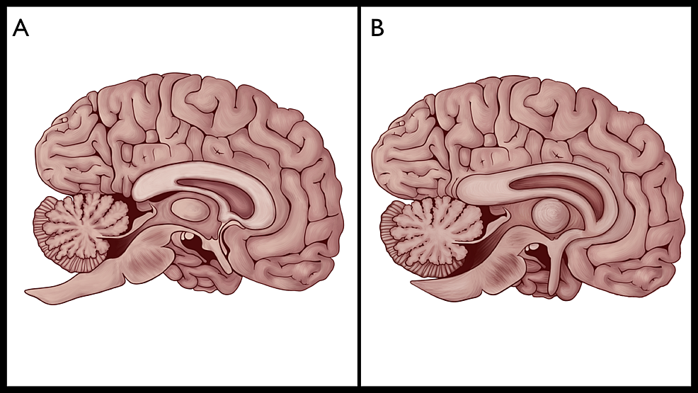 Gross-anatomical-comparison-between-the-human-brain-(A),-and-the-human-brain-described-in-the-ancient-ages-(B).