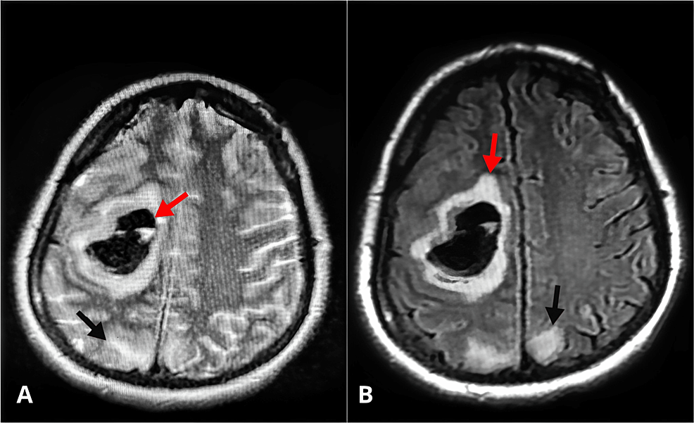 Intracerebral Hemorrhage Mri