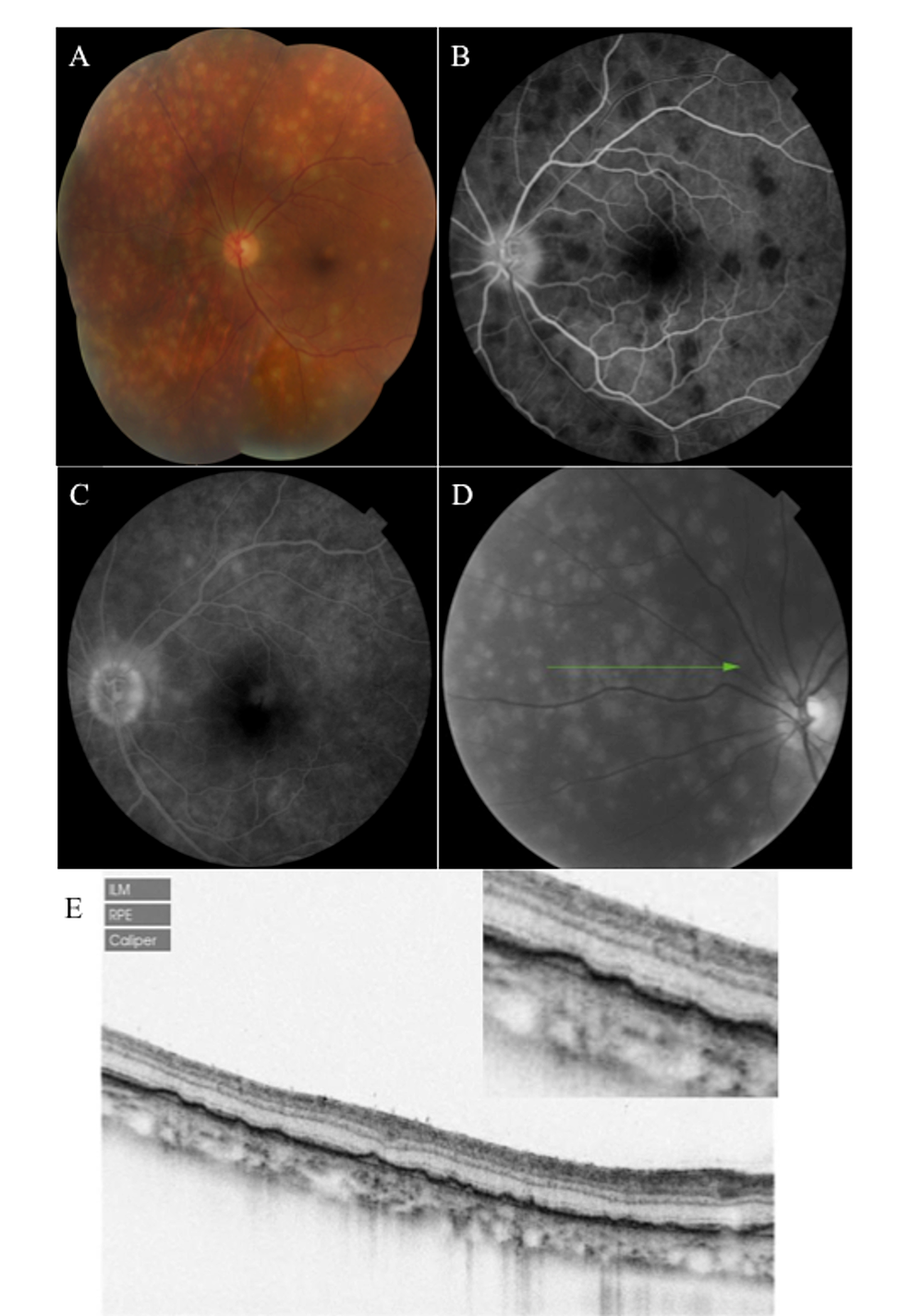 cureus-imaging-of-classic-dal-n-fuchs-nodules-in-sympathetic