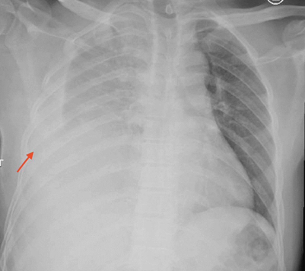 Right Diaphragmatic Rupture A Case Report of a Rare Surgical Trauma