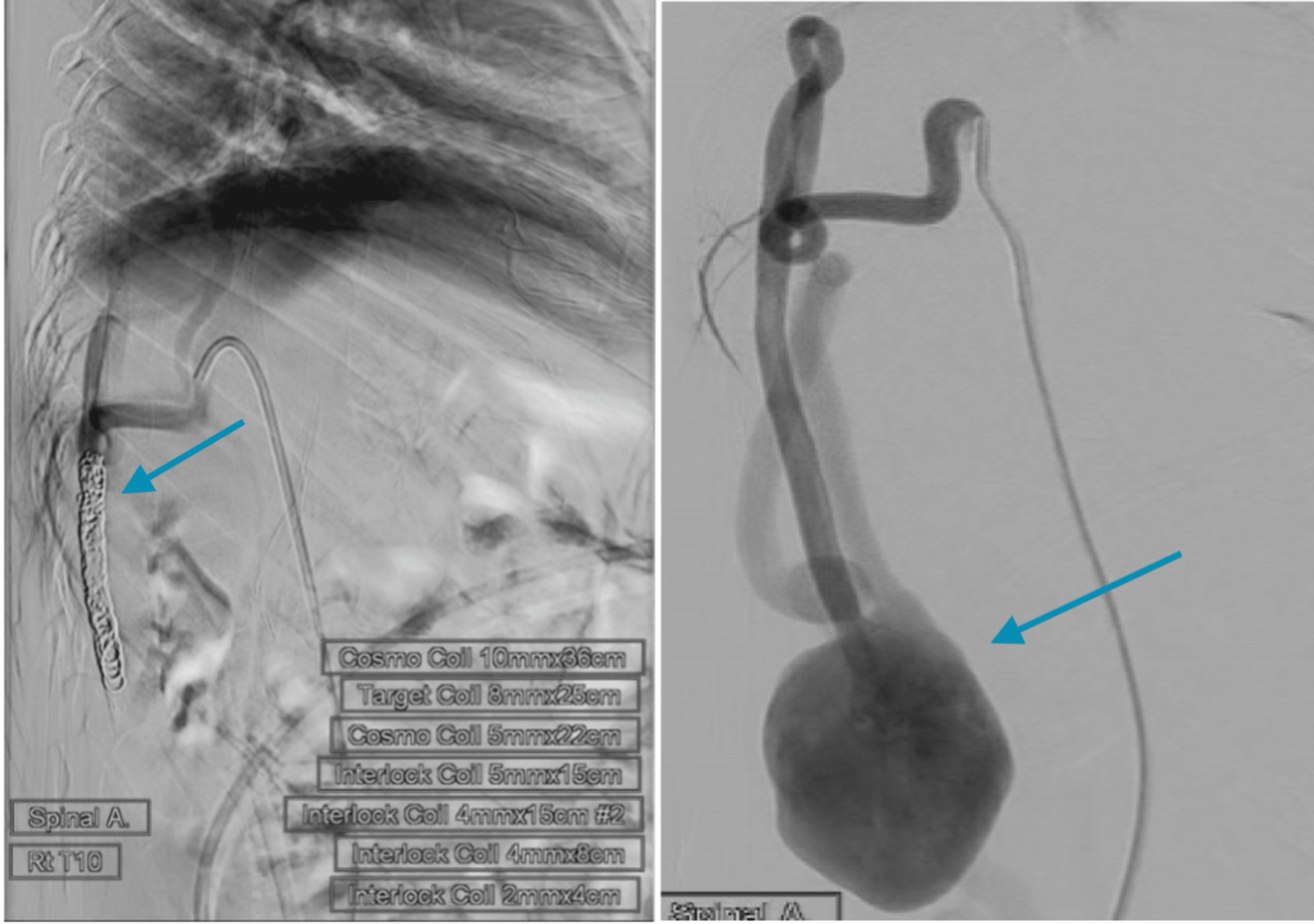 Cureus Salvageable Intrastent Coil Embolization Treatment for Spinal