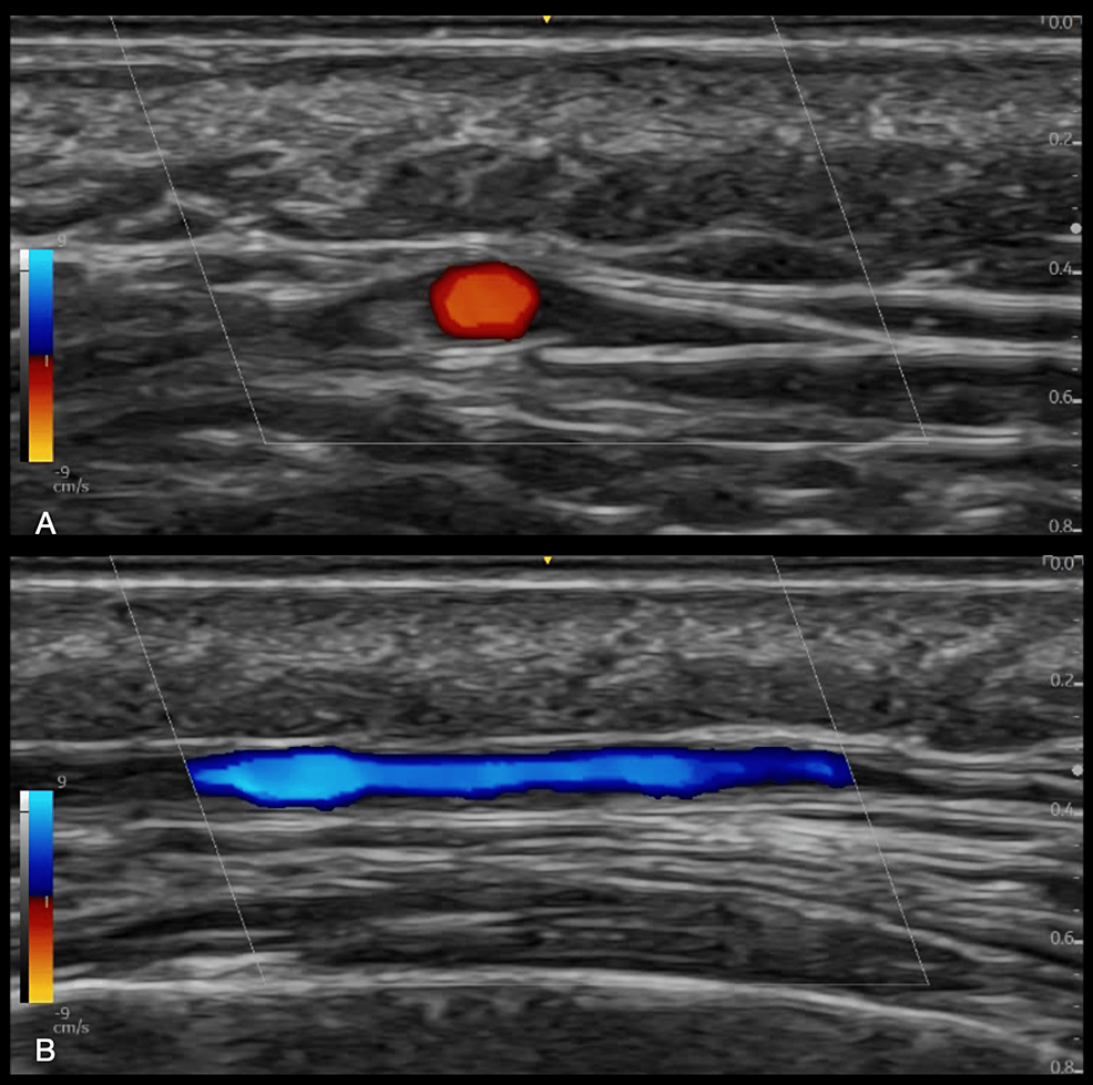 Temporal Artery Ultrasound For The Diagnosis Of Giant Cell Arteritis In The Emergency Department