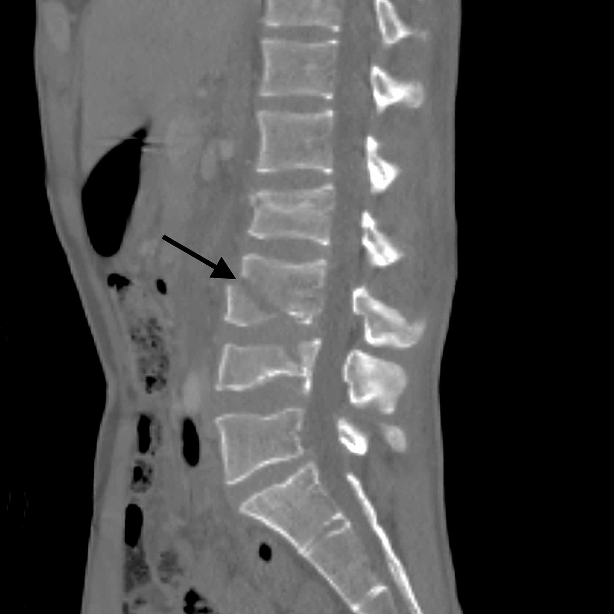 Lumbar Fracture Types Vrogue Co