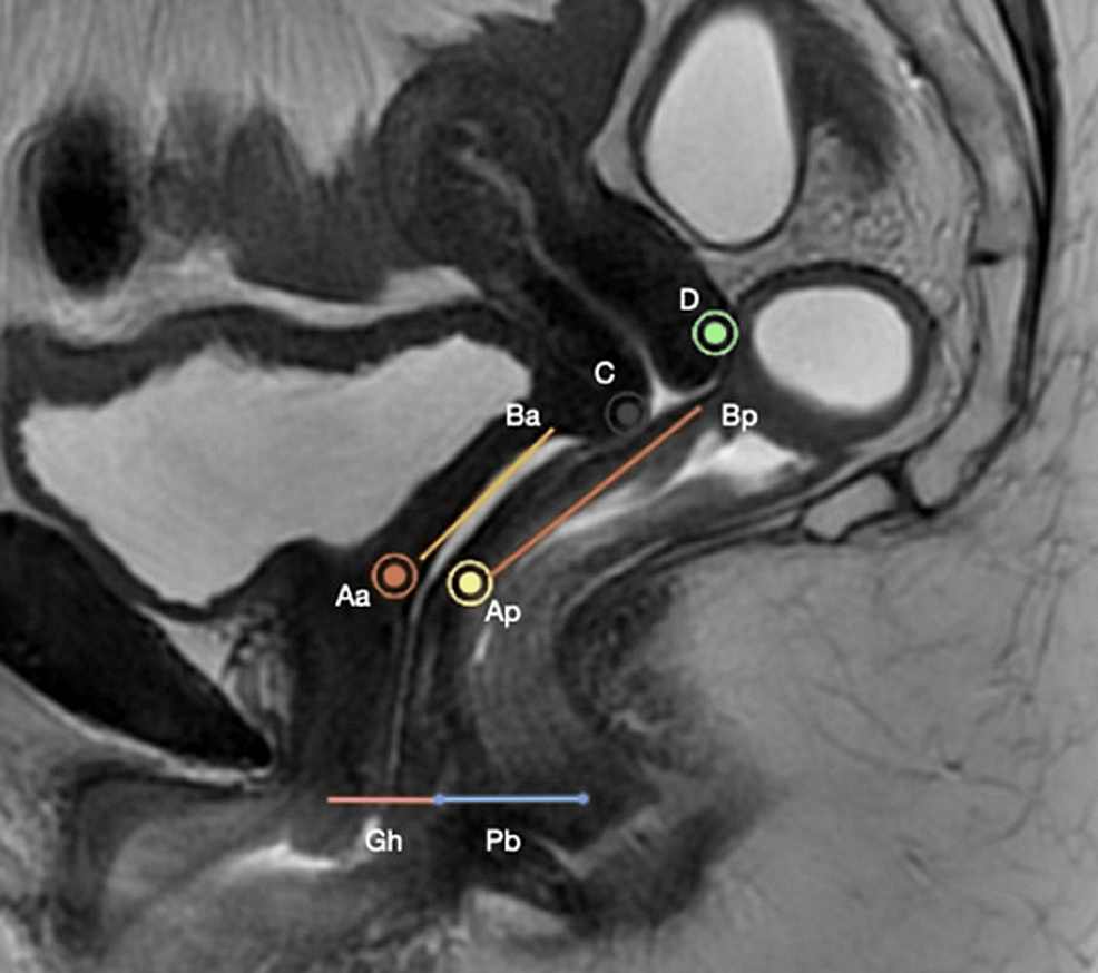 Cureus  Static and Dynamic Magnetic Resonance Imaging in Female