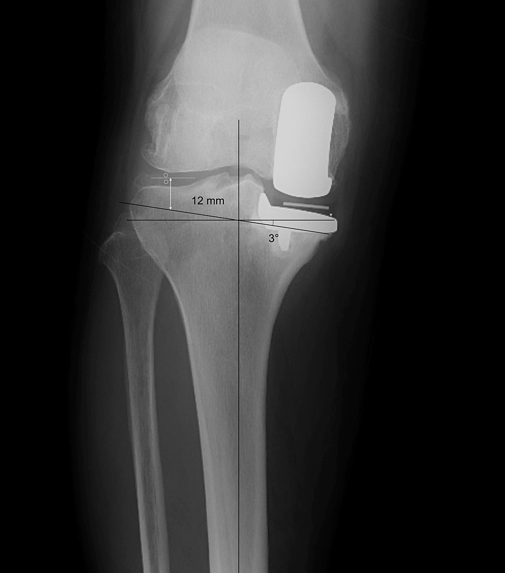 Restricted Kinematically Aligned Total Knee Arthroplasty Following
