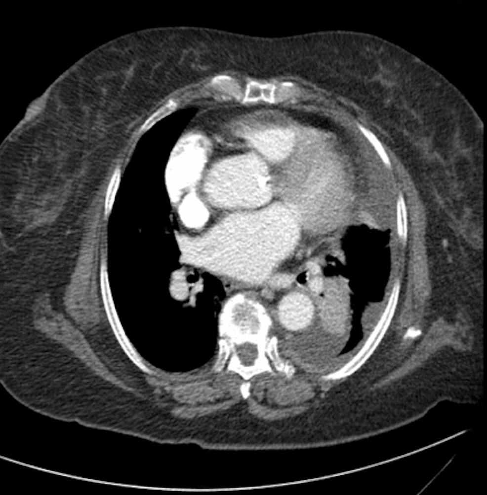 Pleural Epithelioid Hemangioendothelioma (EHE): A Case Report | Cureus