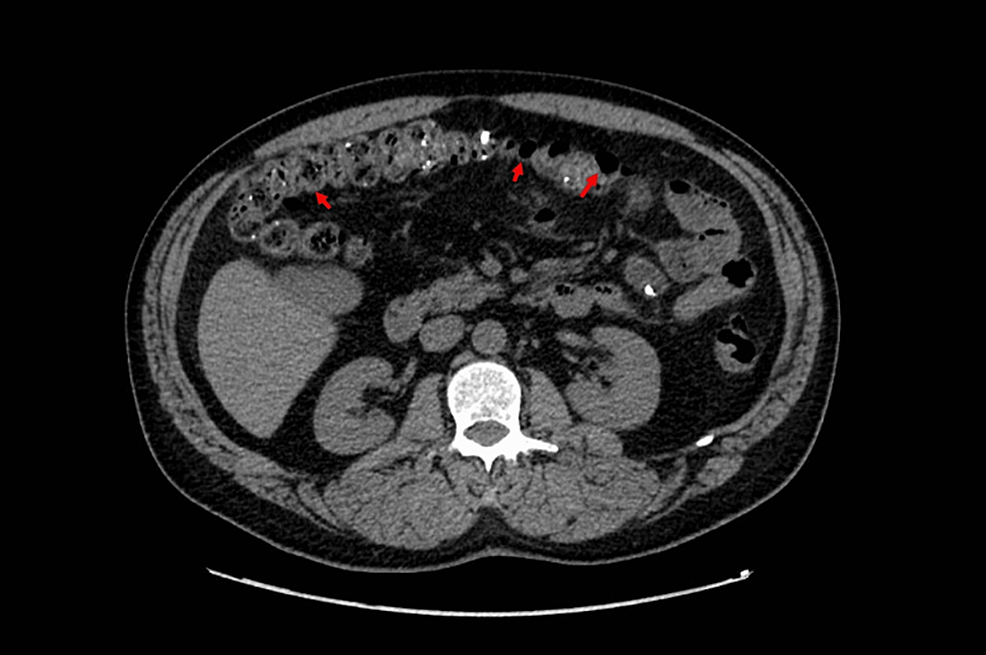 Cureus | Intestinal Reactive Amyloid A (AA) Amyloidosis in a Patient ...