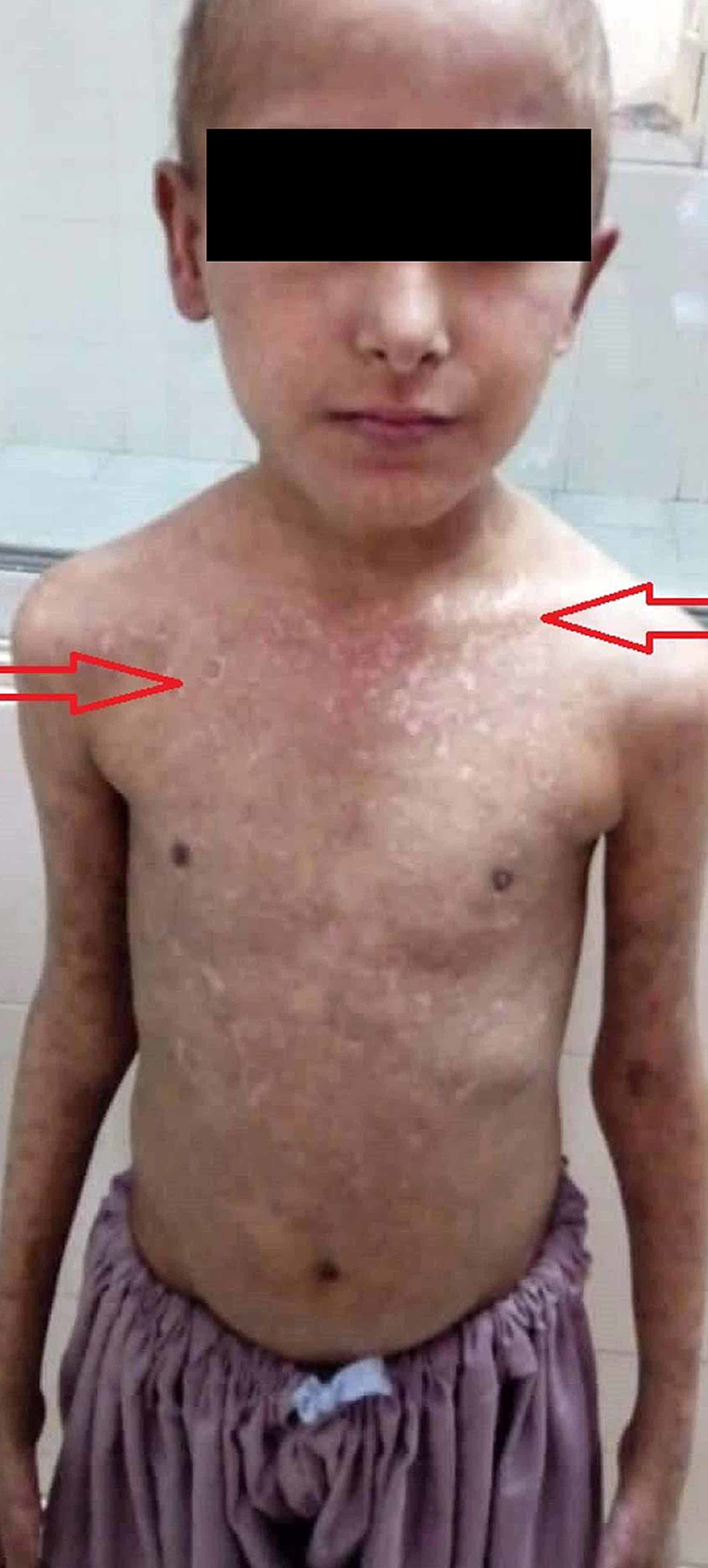 cureus-the-first-case-of-rowell-syndrome-with-lupus-nephritis-and