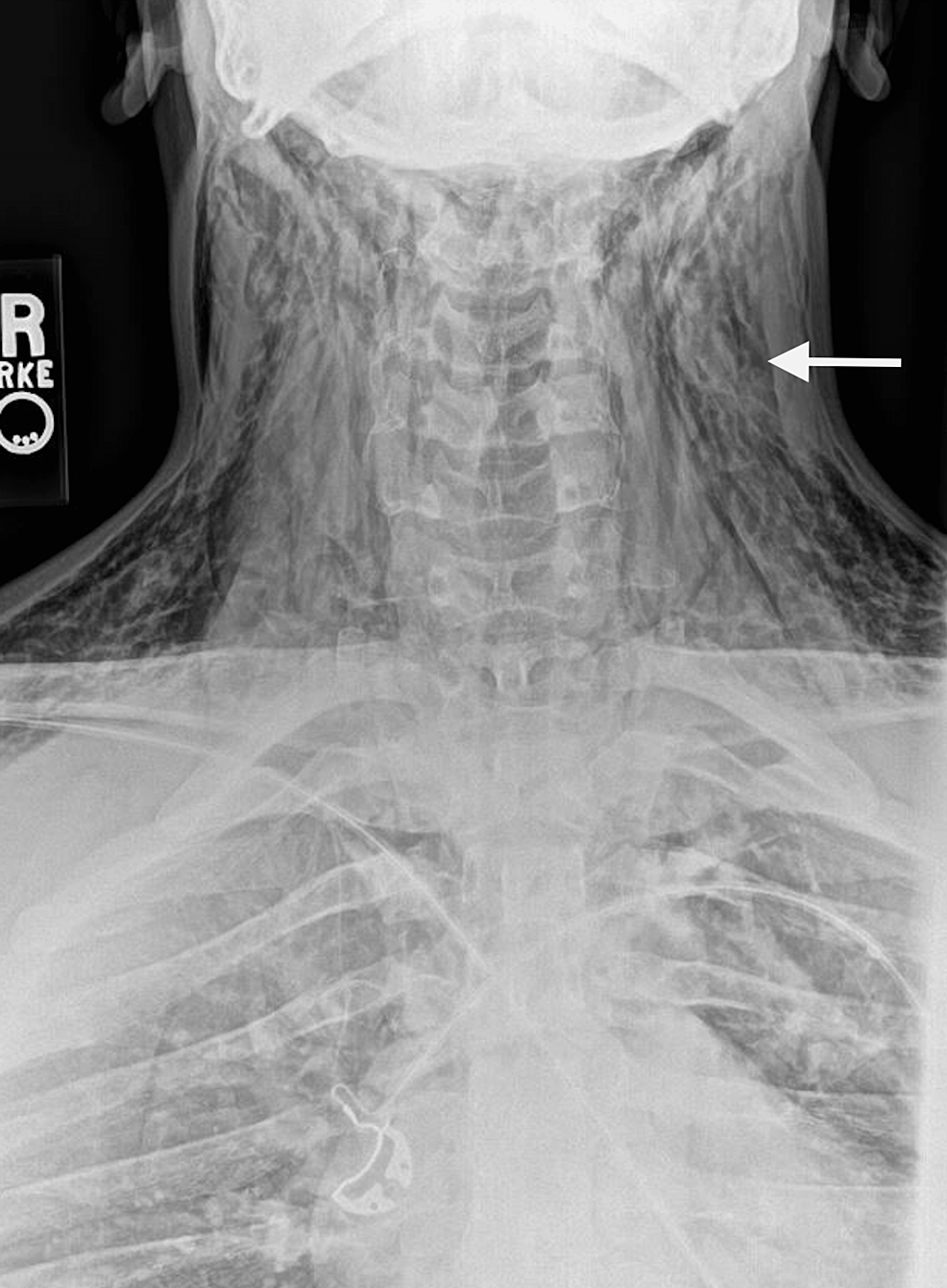 Cureus Pulmonary Barotrauma After Diving Without Breathing Equipment