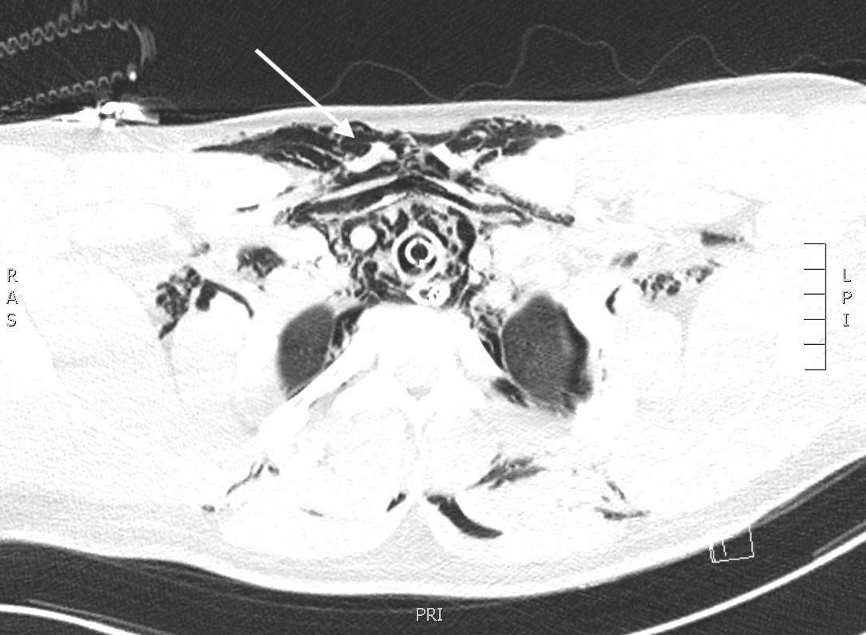 Cureus Pulmonary Barotrauma After Diving Without Breathing Equipment