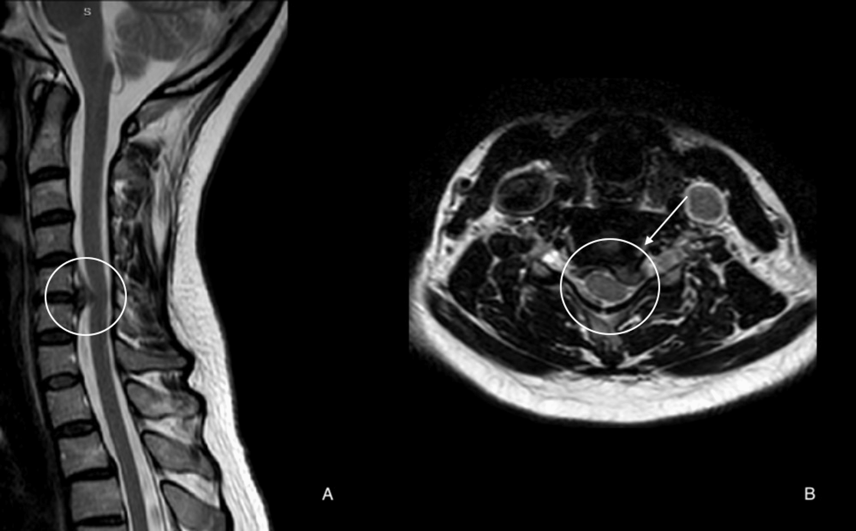 Cureus Unexpected Recovery A Report On The Spontaneous Regression Of A Herniated Cervical Disc