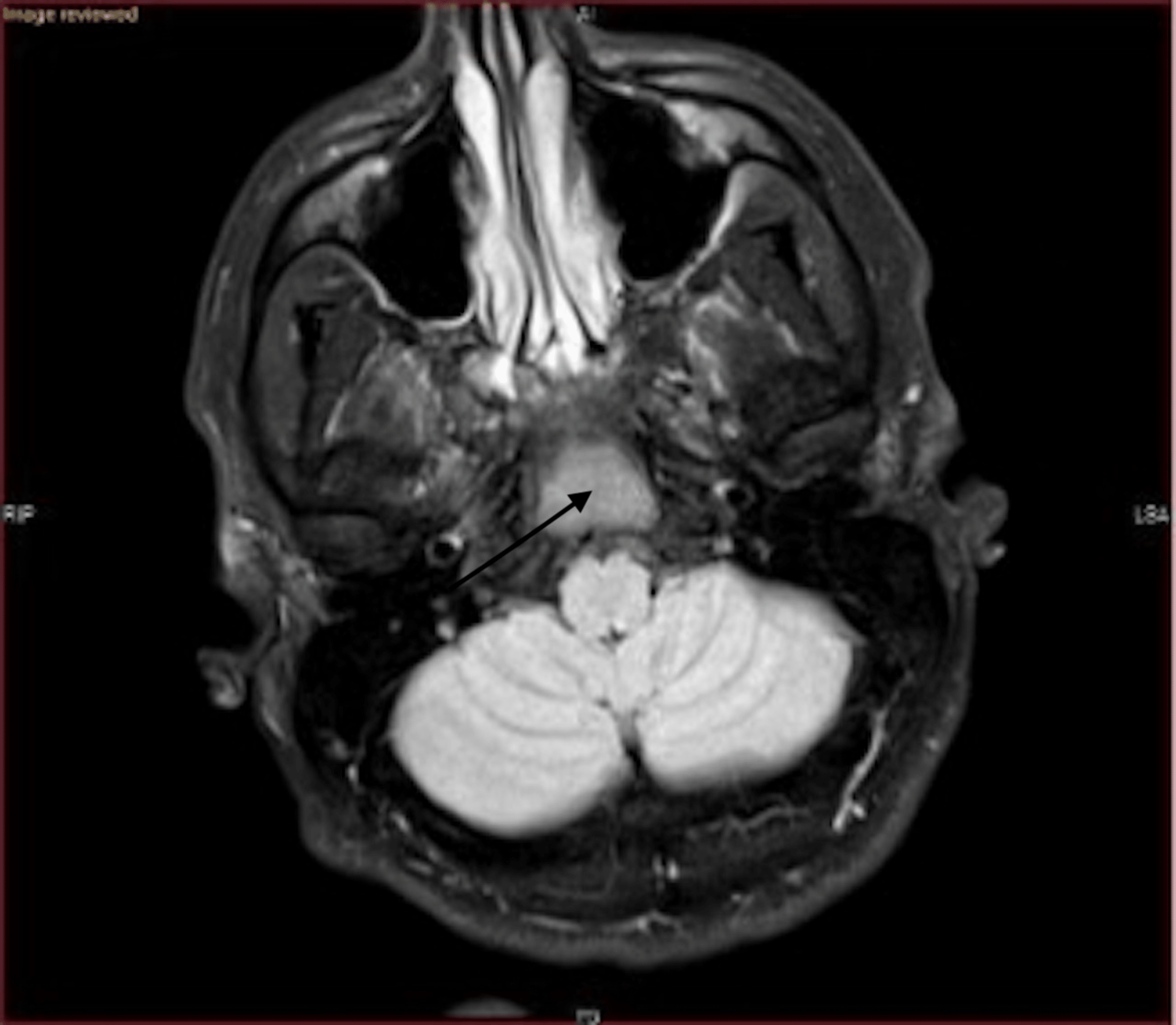 Cureus | Fibrous Dysplasia of the Clivus: Case Report and Literature Review