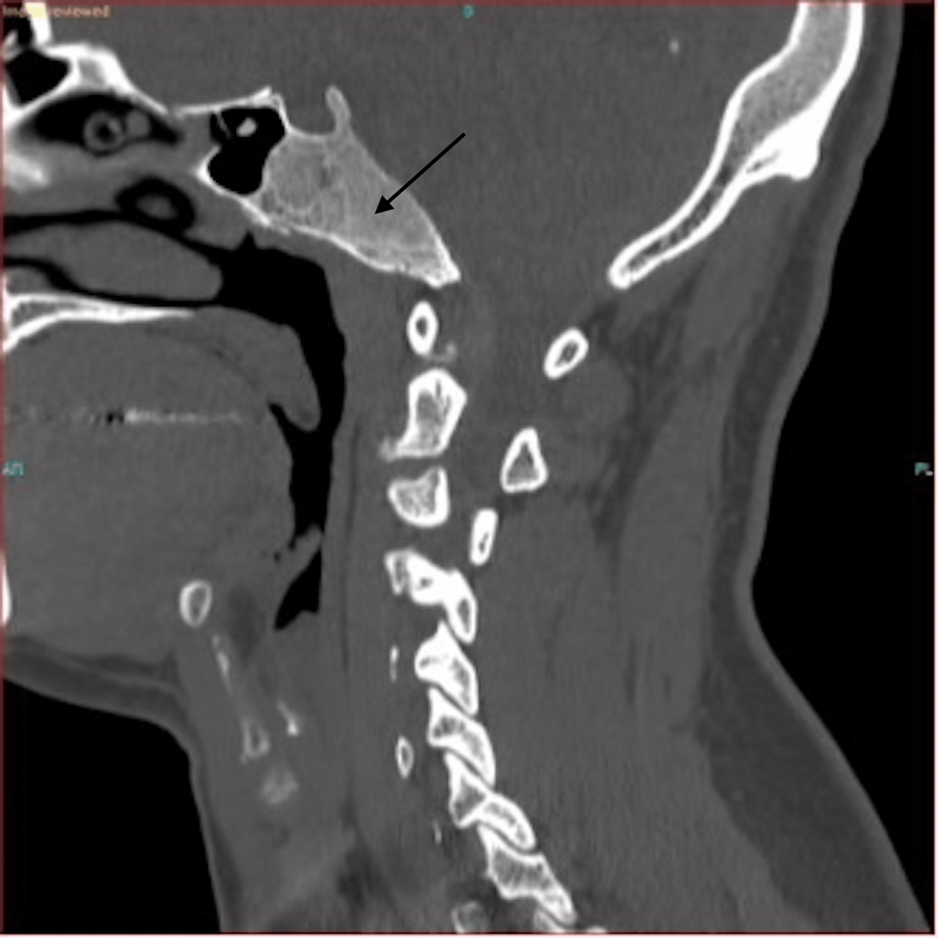 Cureus | Fibrous Dysplasia of the Clivus: Case Report and Literature Review