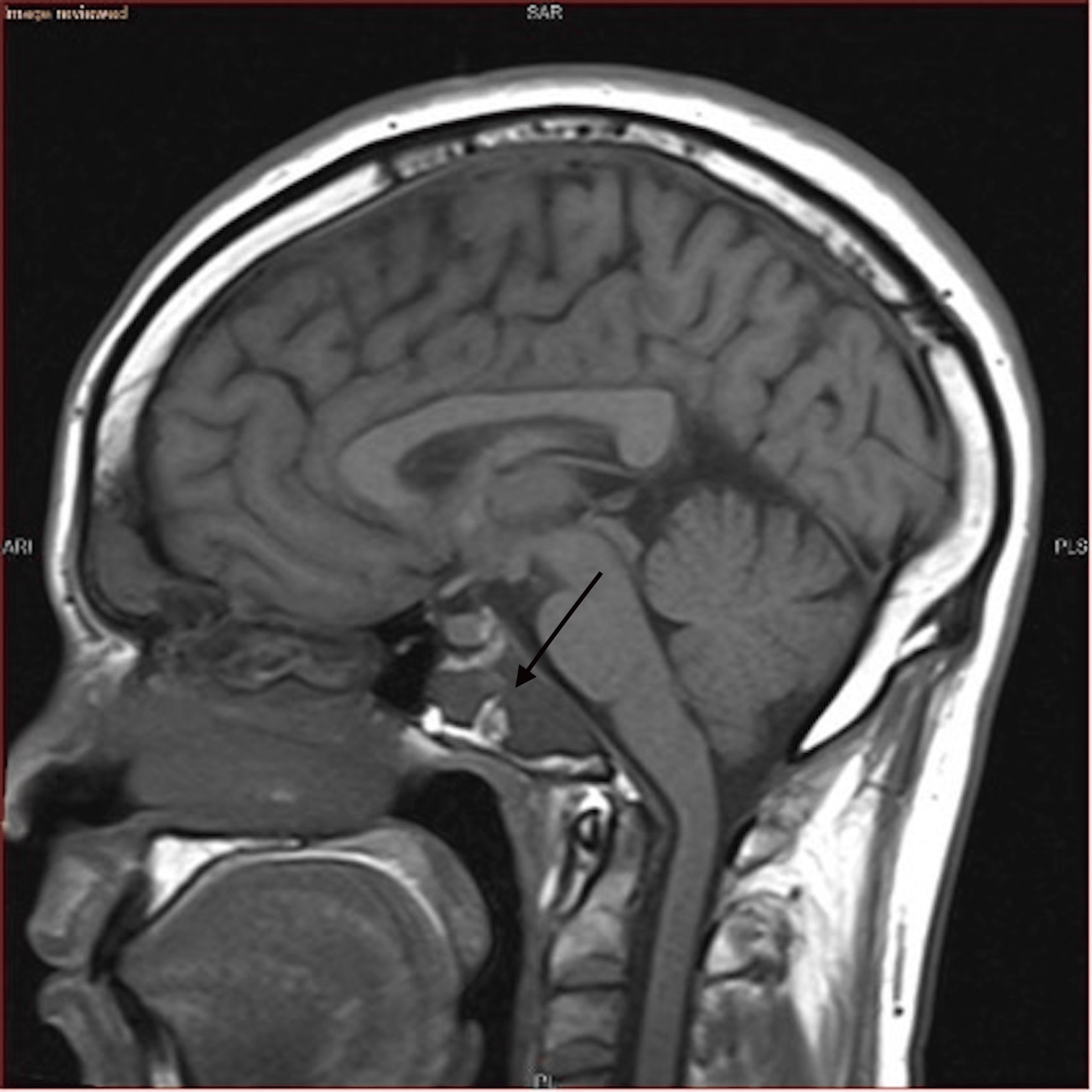 Cureus | Fibrous Dysplasia of the Clivus: Case Report and Literature Review