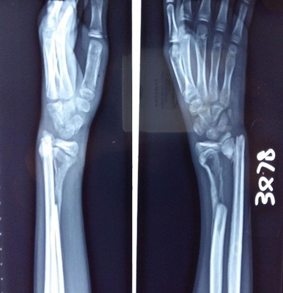 Cureus Spontaneous Bone Regeneration in an Open Segmental Fracture of