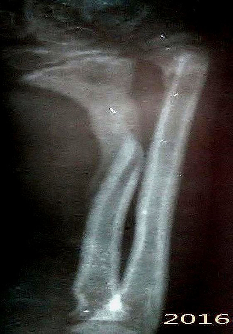 Spontaneous Bone Regeneration in an Open Segmental Fracture of the