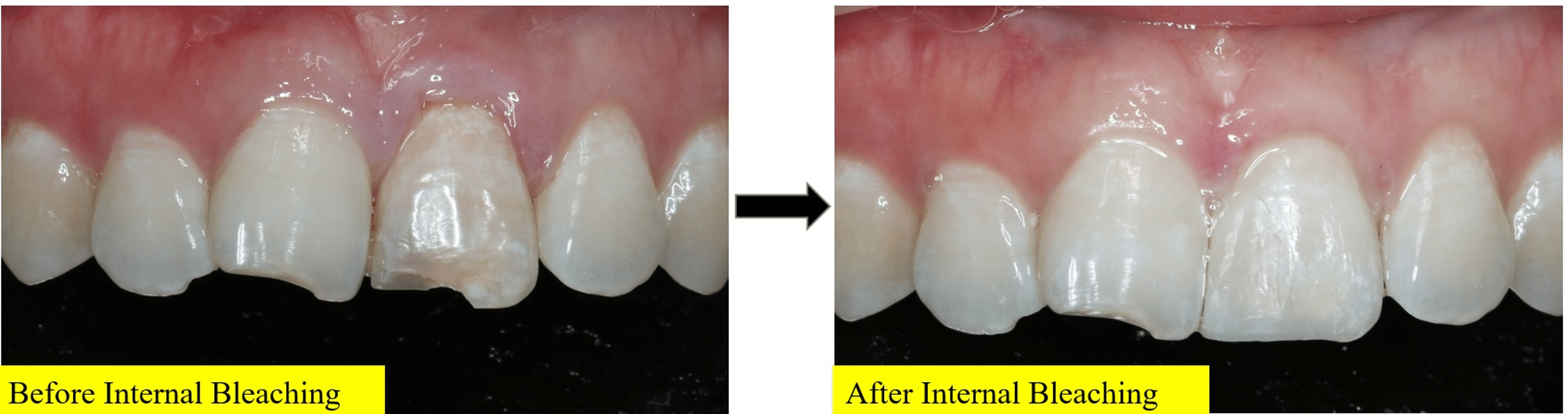 Endodontic Microsurgery on a Persistent Periapical Lesion Cureus
