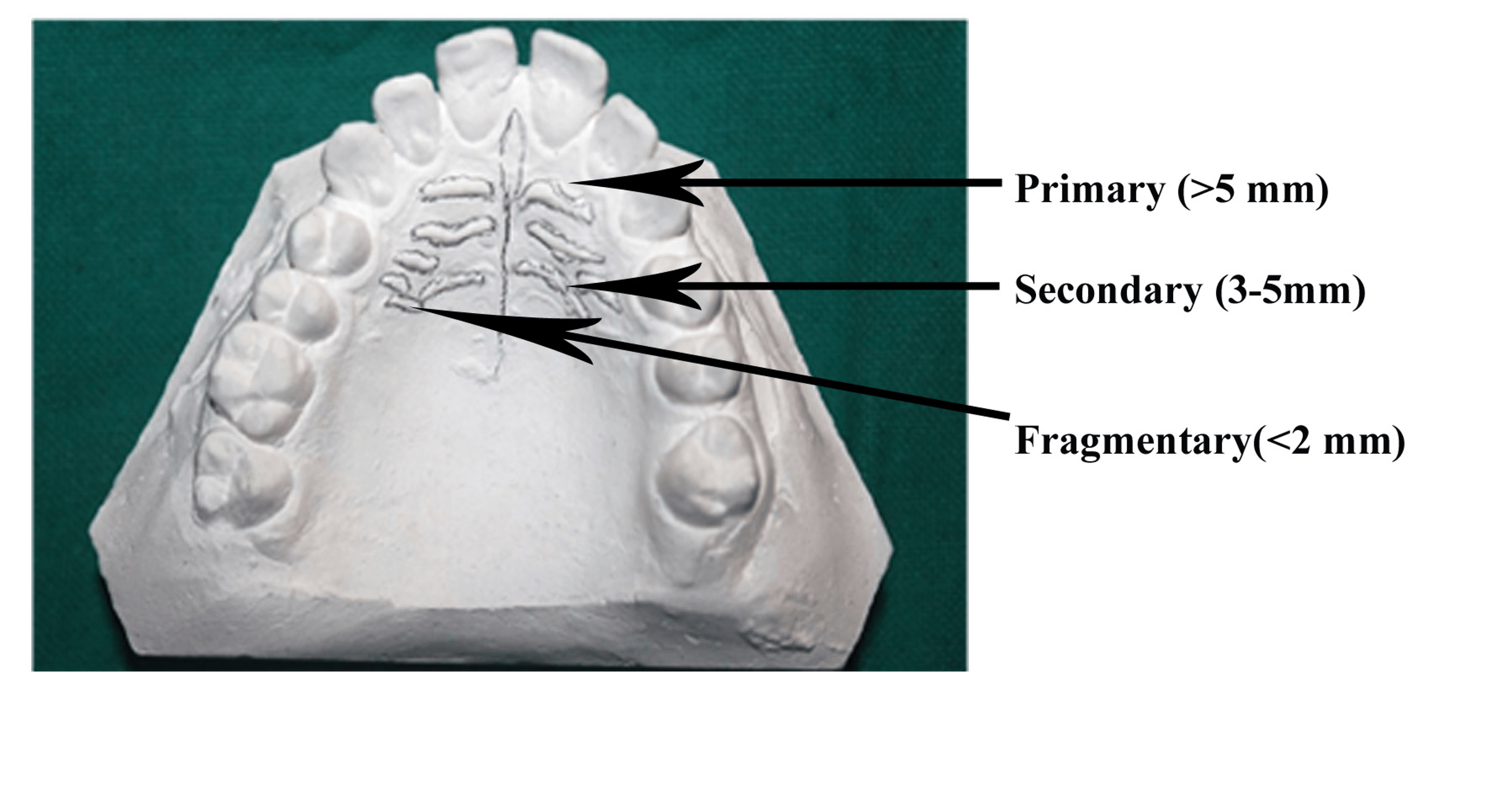 An Association of Morphological Characteristics of Palatal Rugae and