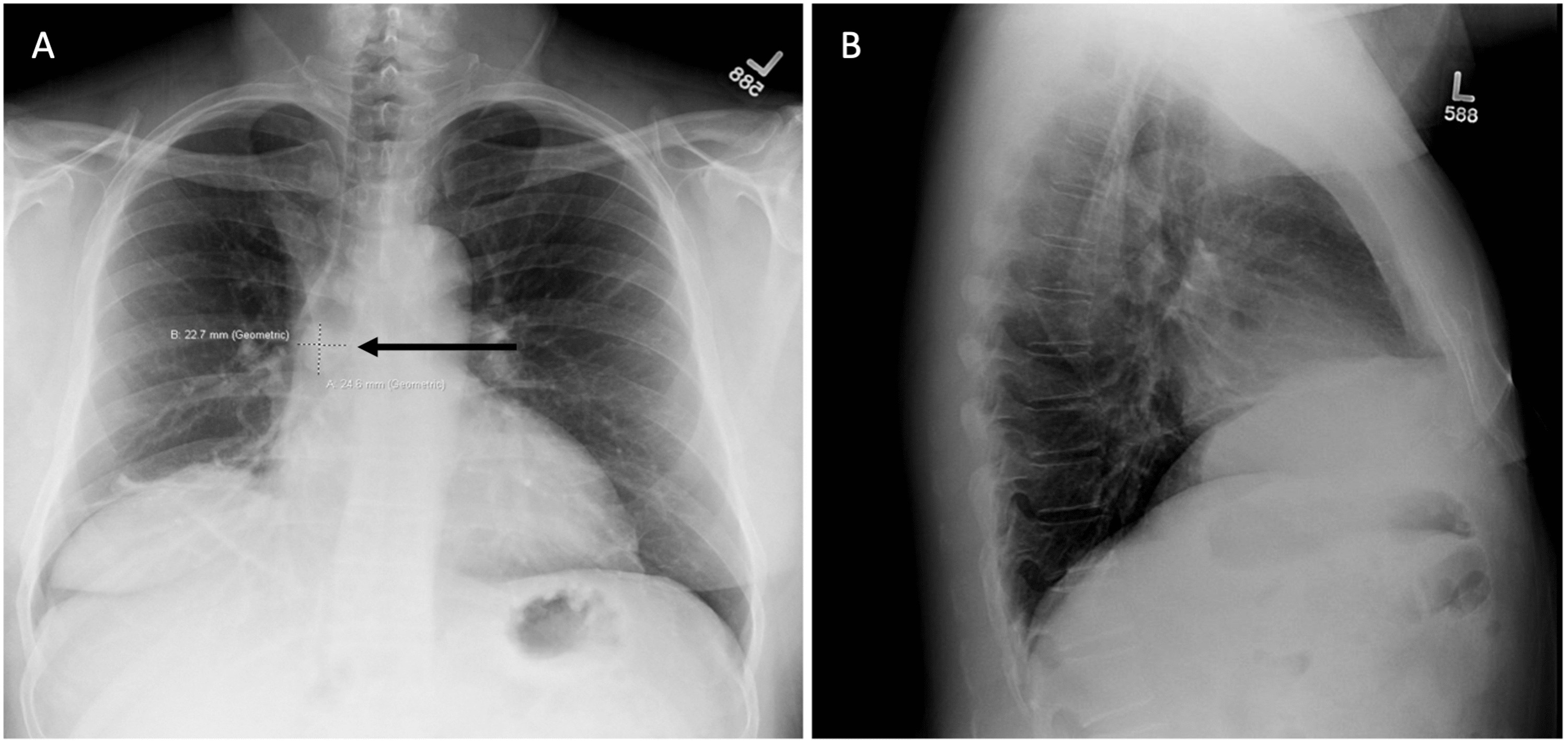 Carcinoid Tumor Presenting as Hemoptysis and Elevated Diaphragm Cureus