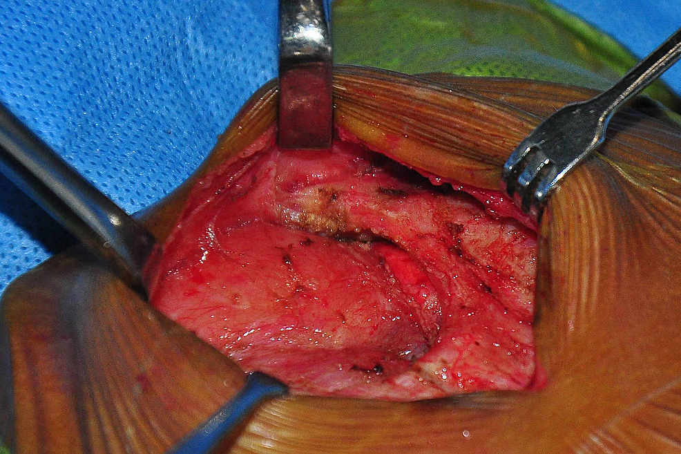 Cureus | Primary Closure of a Partial Superior Sternal Cleft in a 27