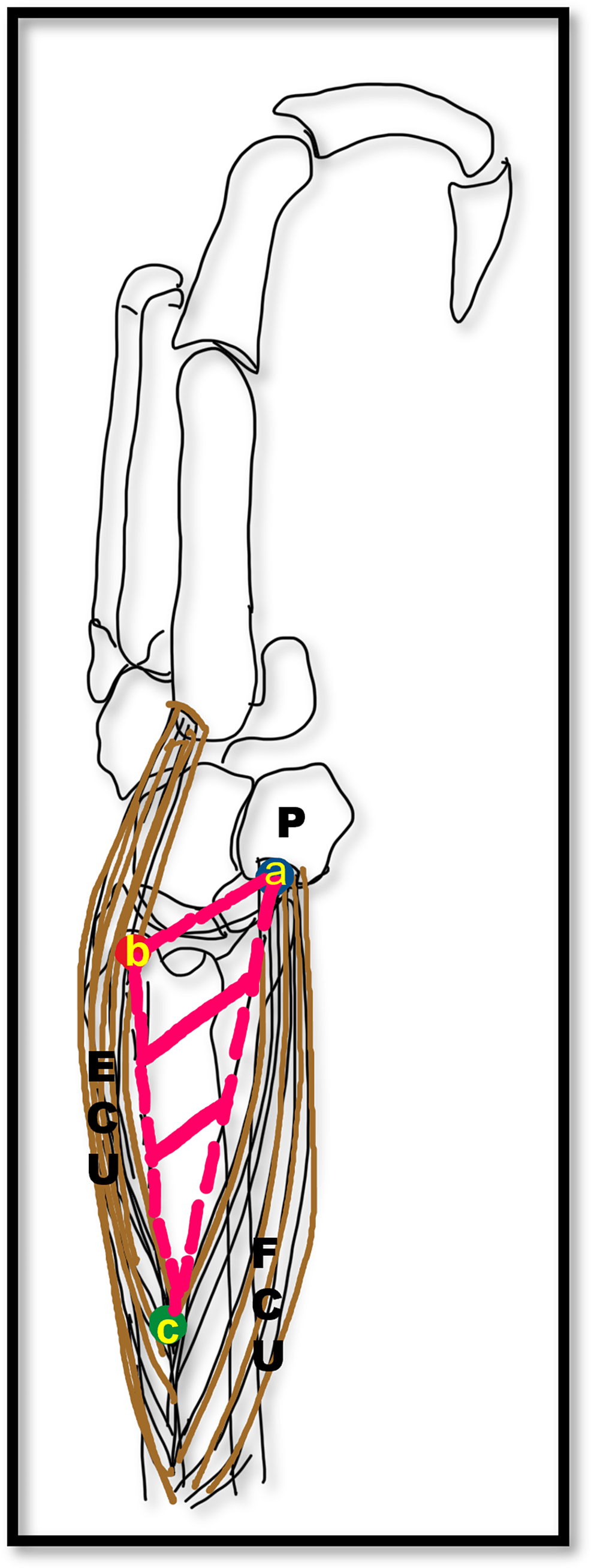 Subcutaneous Dorsomedial Triangle Of Forearm: Surgical Anatomy And ...