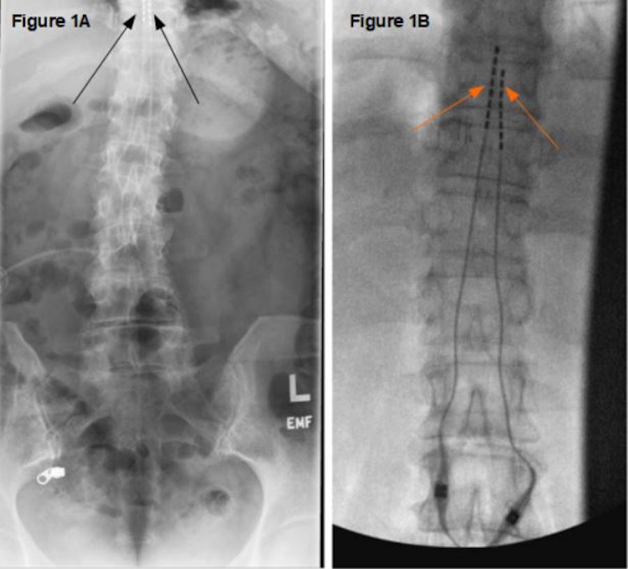 symptoms of spinal cord stimulator rejection