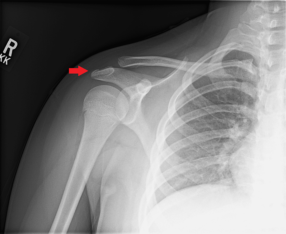 Iliac crest apophyseal avulsion fracture, Radiology Case