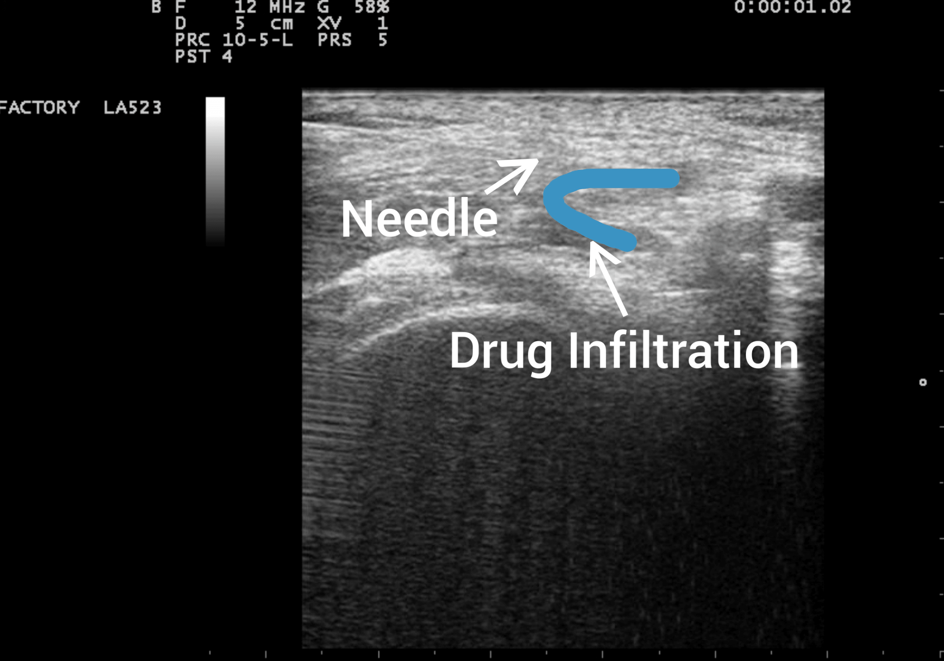 Effects of UltrasoundGuided Lower Extremity Nerve Blocks for Below