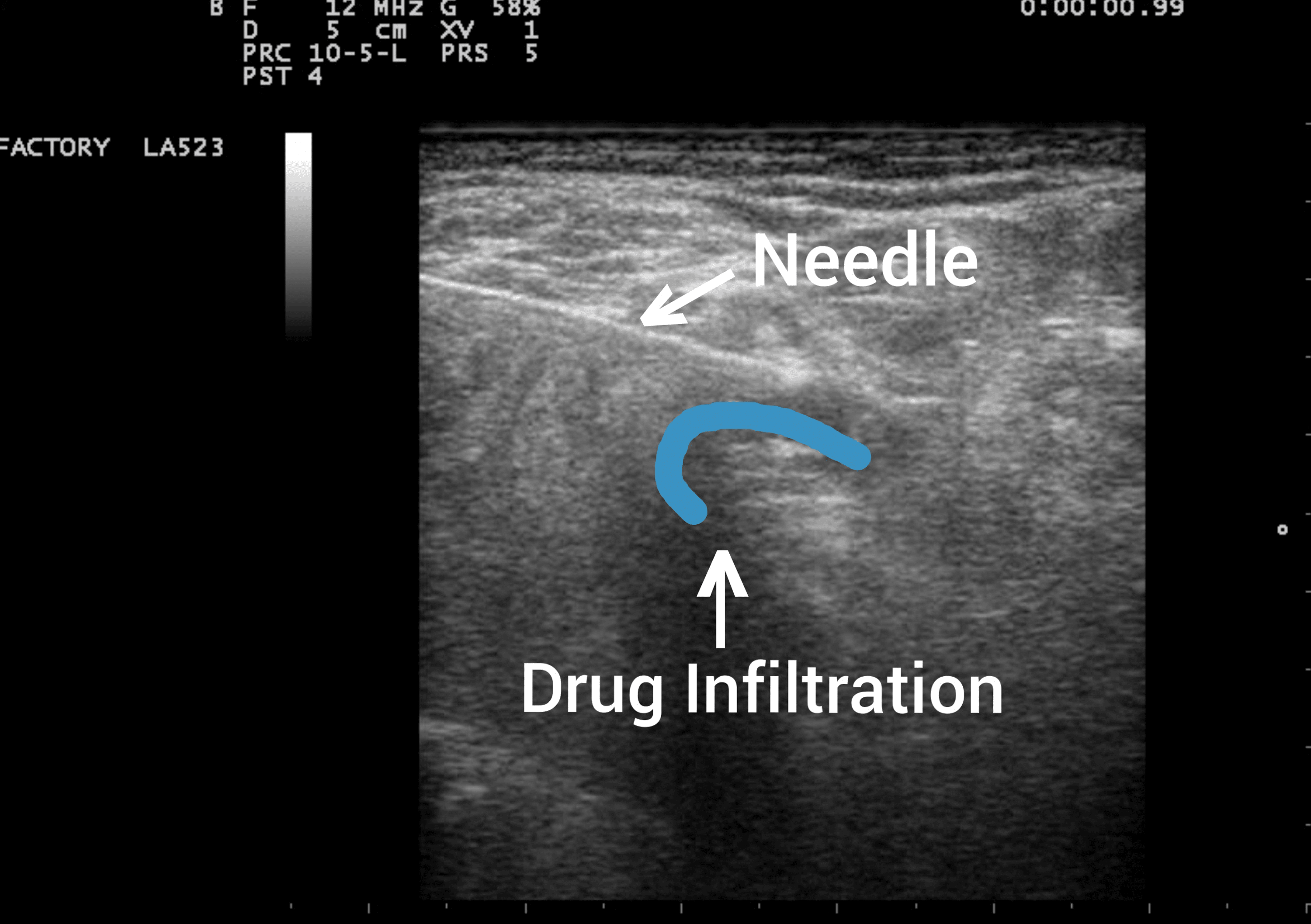 Effects of UltrasoundGuided Lower Extremity Nerve Blocks for Below