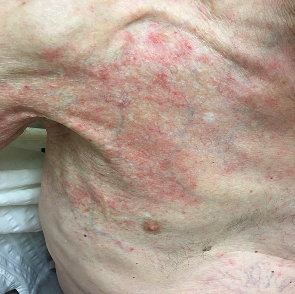 Cureus Radiation Recall in a Patient with Intrahepatic