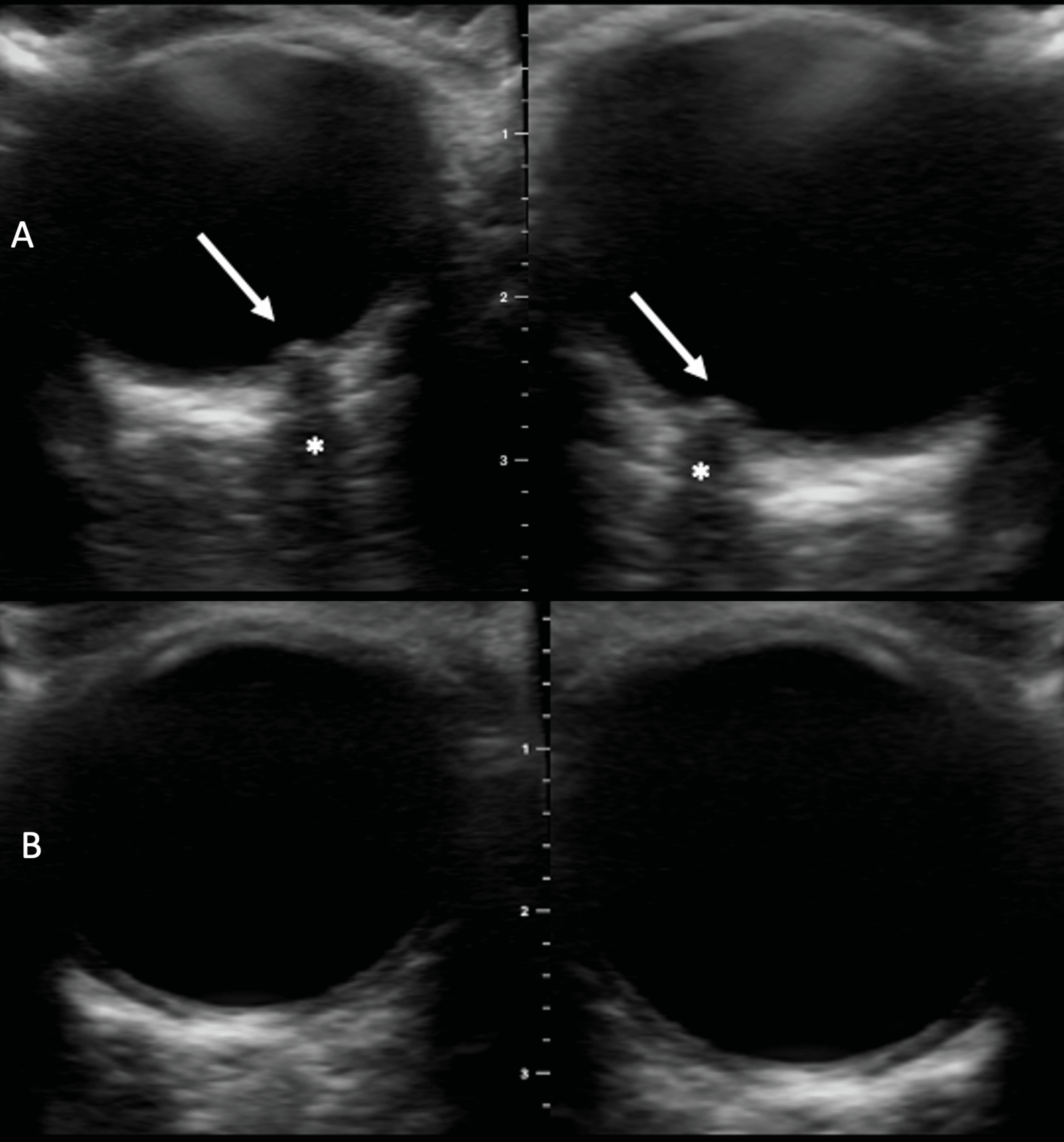 Cureus Optic Disc Elevation Secondary to Cerebral Malaria Resolves