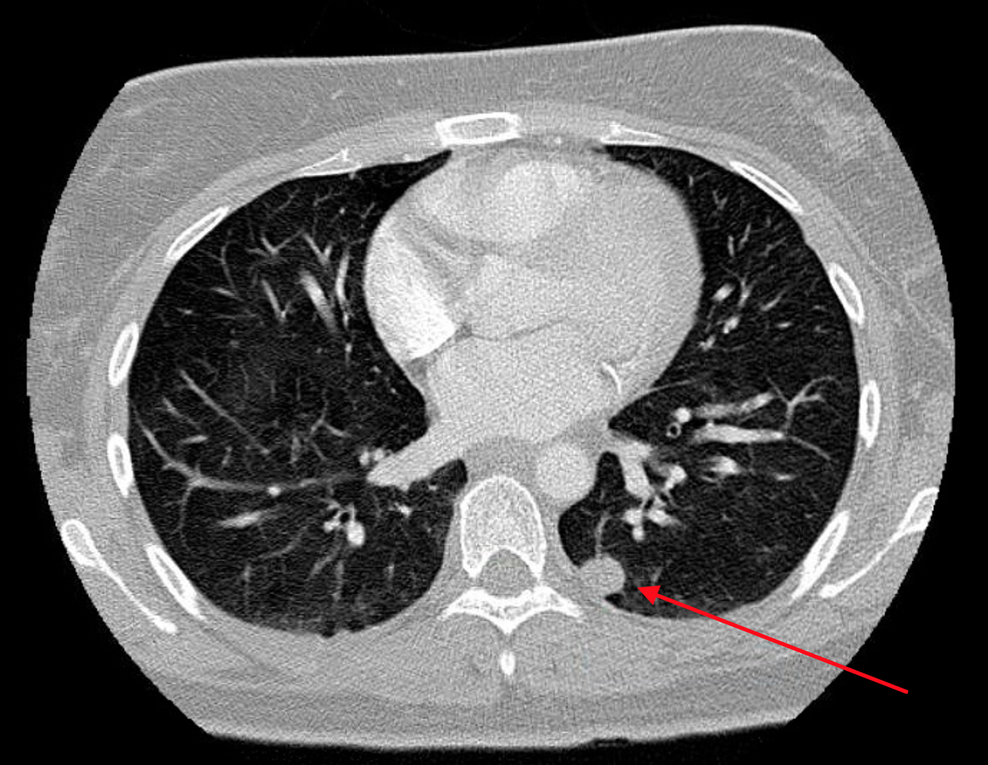 Cureus | Brain Metastasis in a Young Patient with Uterine Carcinosarcoma