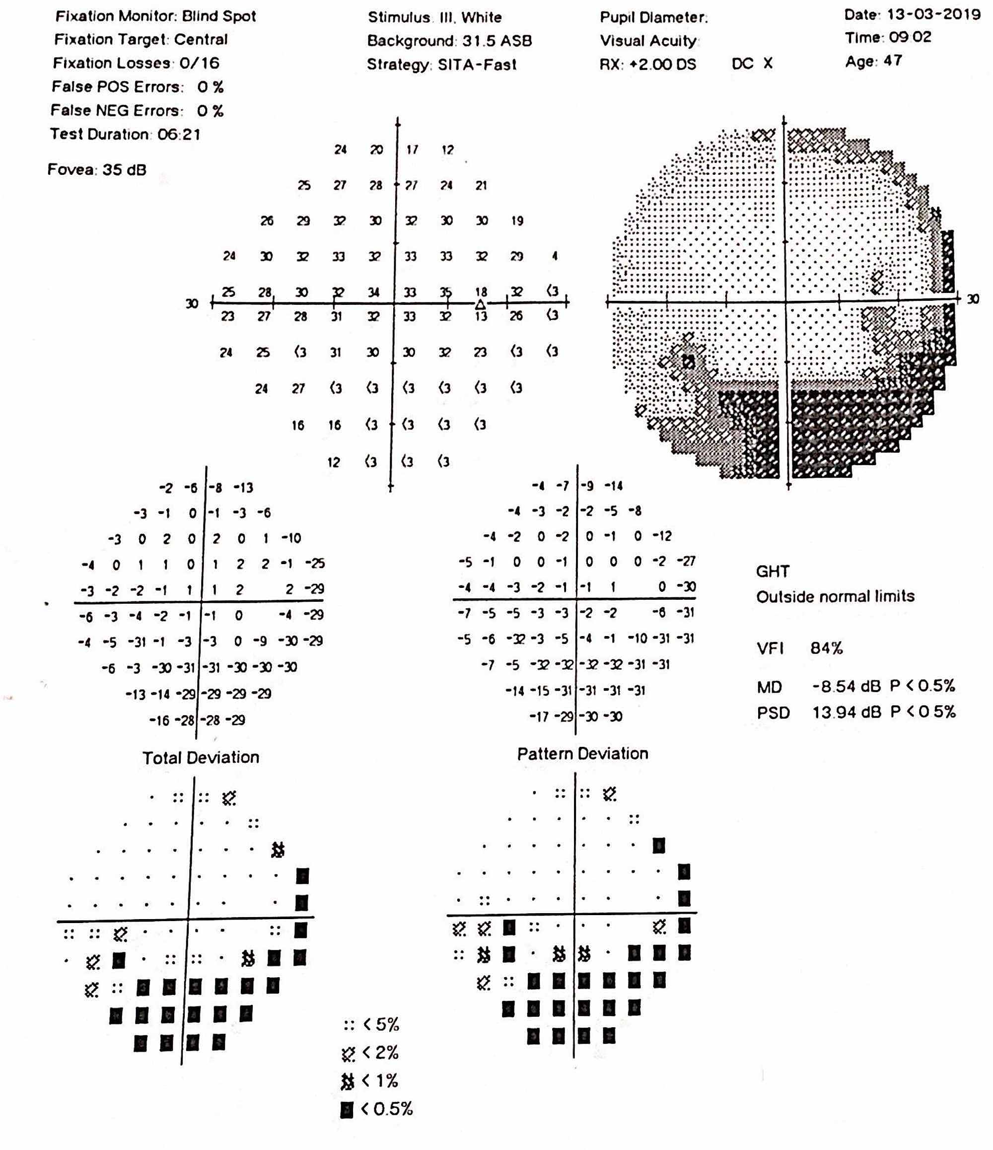 Cureus Systemic Lupus Erythematosus Presenting as Optic Neuropathy A