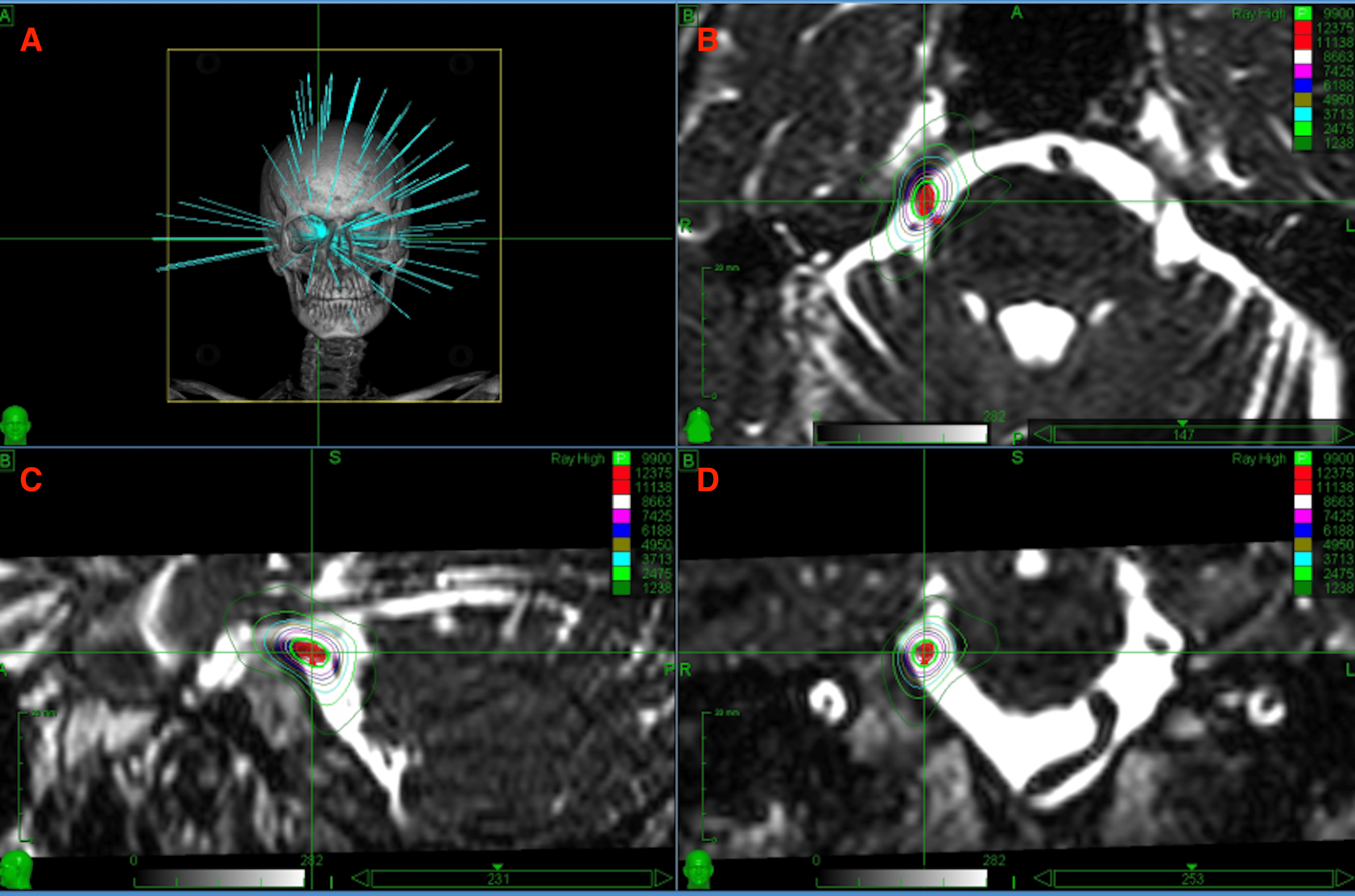 Cureus A Pilot Study of Hypofractionated Radiosurgery for Trigeminal Neuralgia