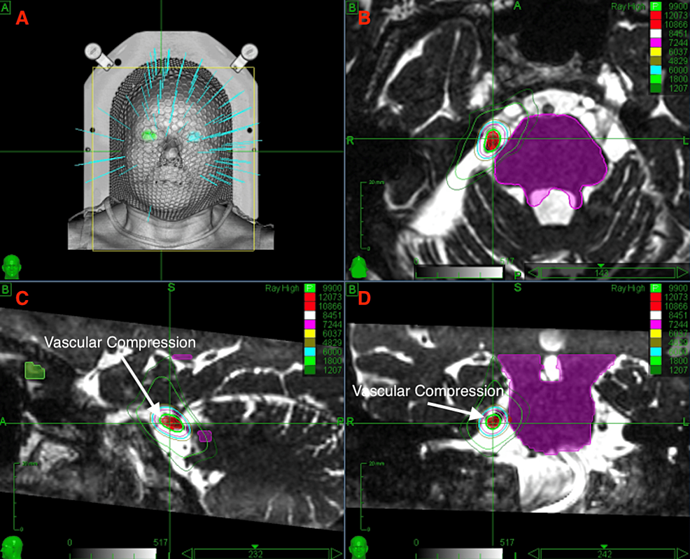 Cureus A Pilot Study of Hypofractionated Radiosurgery for Trigeminal