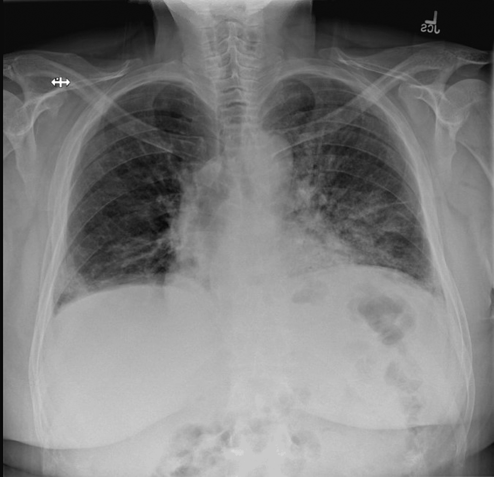 Cureus | Pulmonary Renal Syndrome in ANCA-Negative Vasculitis