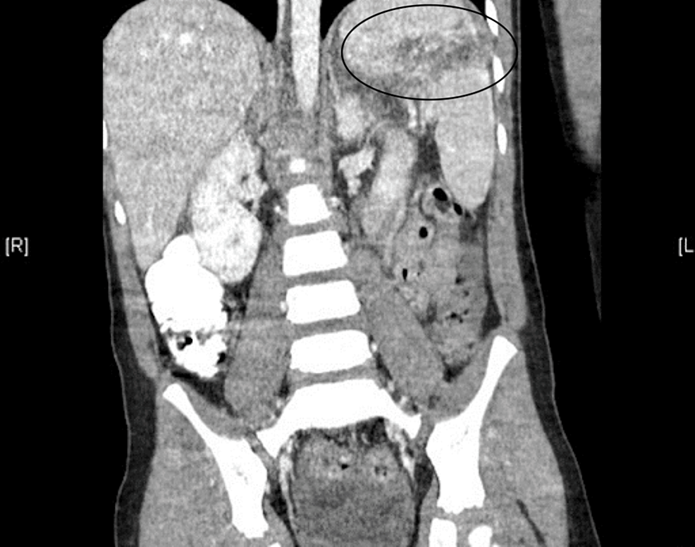 Cureus | Grade III Splenic Laceration After a Ground-Level Fall in a ...