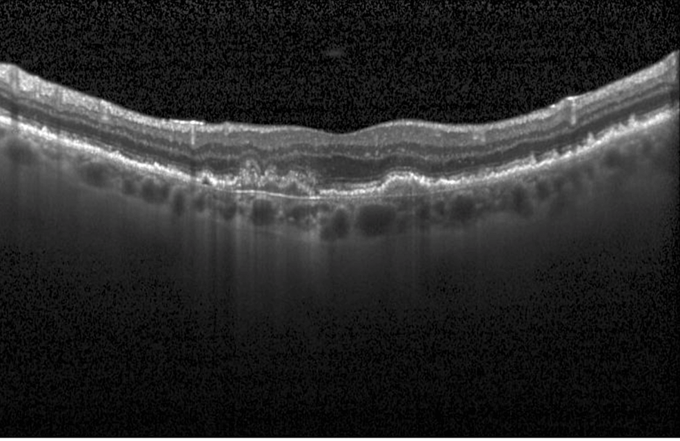 Cureus | Deep Learning Classification of Drusen, Choroidal ...