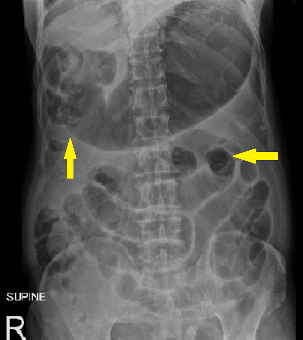 Cureus | Unraveling the Mystery of Hepatic Portal Vein Gas: Exploring ...