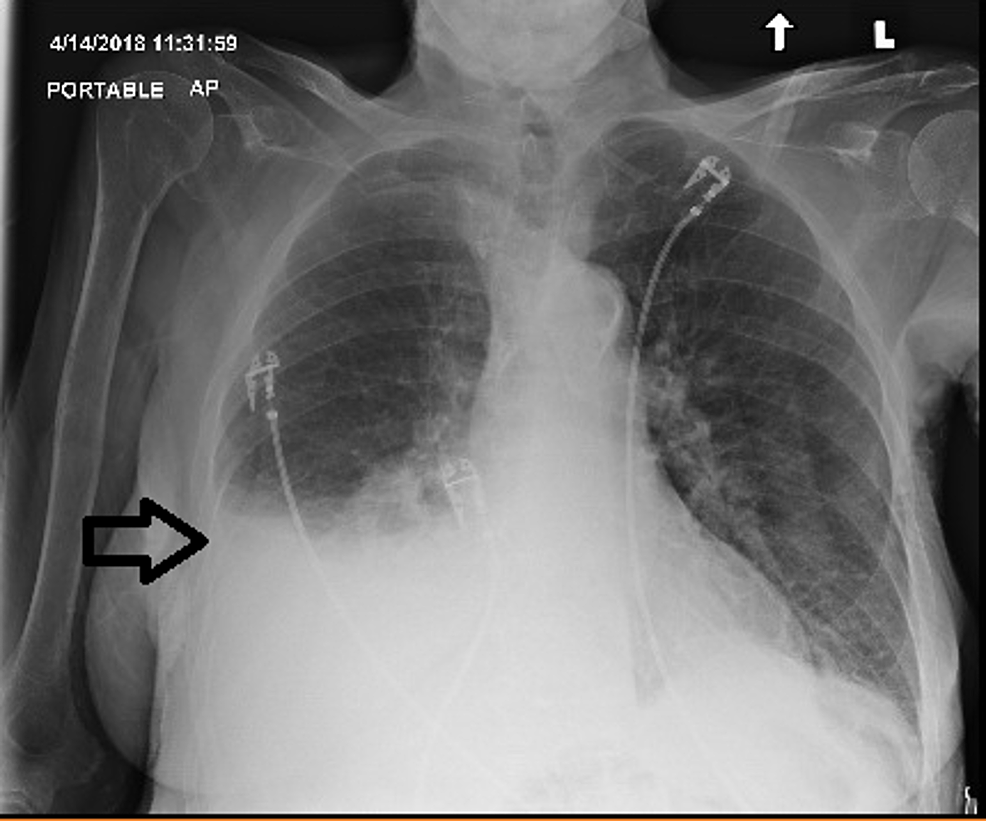 Cureus Adult Onset Morgagni Hernia Medical Vs Surgical Management