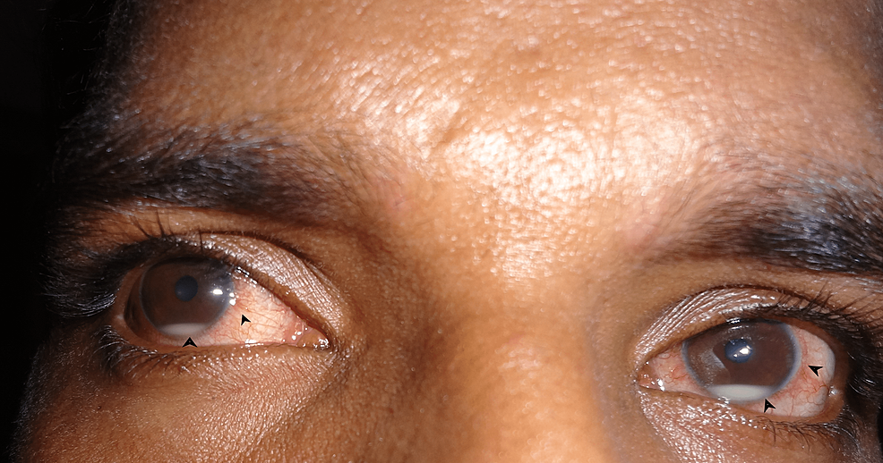 Cureus  Ocular Complications in Patients on Highly Active