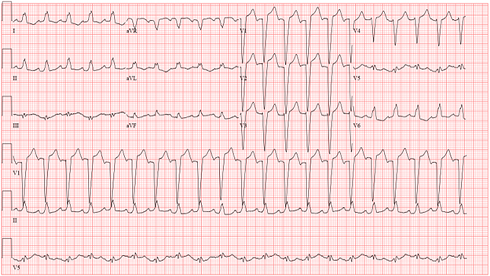 Percutaneous Axillary Left Ventricular Support as a Lifesaving Measure ...